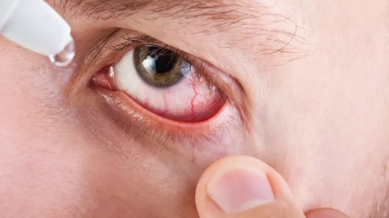 منظمة الصحة العالمية تعلن مصر خالية تماماً من مرض التراكوما المعدي